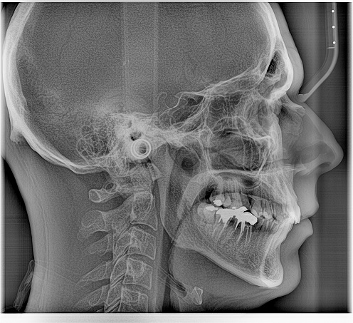 Zdjęcie RTG cefalometryczne - cefalometria